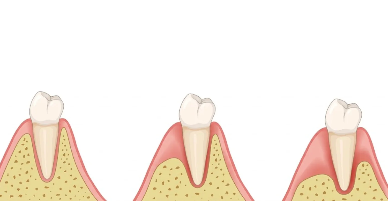 Alveolar Ridge Preservation After Tooth Extraction 2